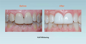 KOR teeth whitening Bel Air MD