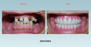 dentures bel air maryland