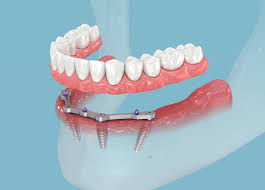 All on four Implants