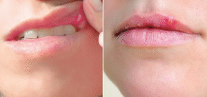 Cold Sore treatment