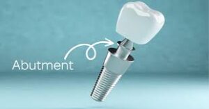 Dental Abutment