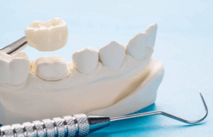 Dental Prosthetics