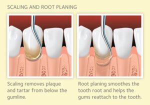 Dental Scaling and Root planning