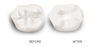 Dental Sealants