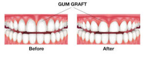 Gum Grafting