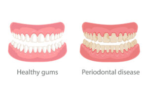 Periodontics & Gum Treatment