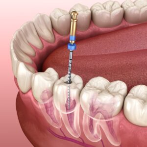 Root Canal Therapy