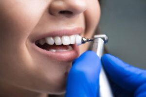 Teeth Polishing