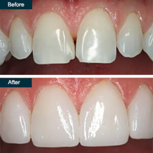 Tooth Repair