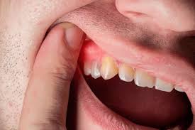 Tooth Sensitivity
