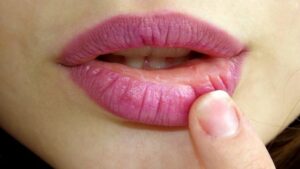 cold sore treatment