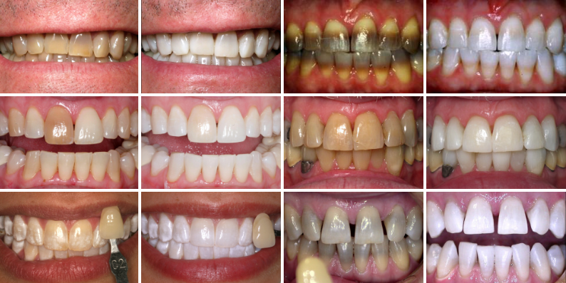 KoR Whitening