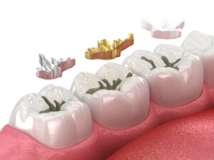 Dental Fillings