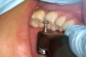 Occlusal Adjustment