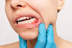 Oral Pathology
