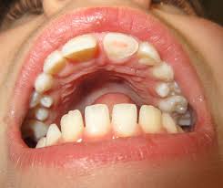 Oral Trauma