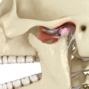TMJ Treatment